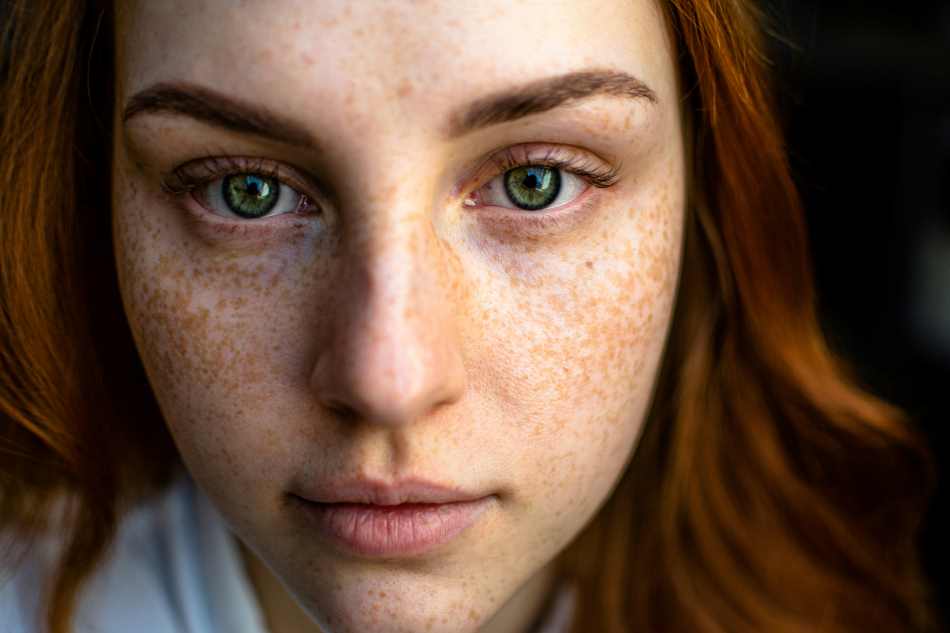 Dark Spots - Melasma